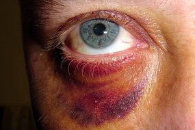 En Papouasie Nouvelle Guinée: appel aux hommes pour lutter contre la violence conjugale – [www.flickr.com: Dion Gillard]